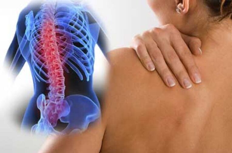 Avec l'ostéochondrose, la douleur peut irradier vers des parties éloignées du corps
