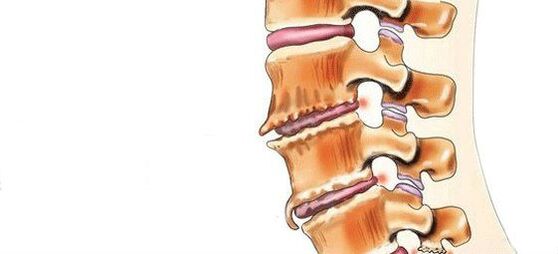 Spondylose - destruction des articulations intervertébrales