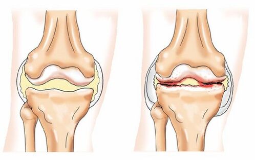 Articulation saine et arthrose