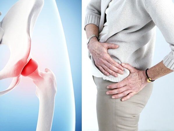 Symptômes d'arthrose de l'articulation de la hanche