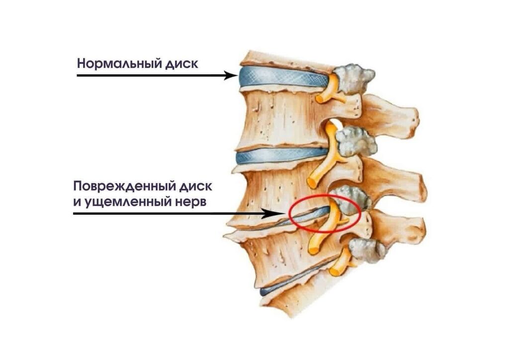 Symptômes de l'ostéochondrose cervicale