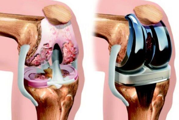 avant et après l'arthrose de l'articulation du genou pour l'arthrose