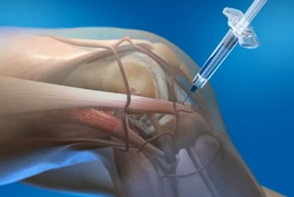 injections intra-articulaires pour l'arthrose de l'articulation du genou